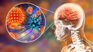 meningitis virus on brain by bali health service